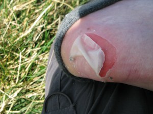 Foot problems, Dales Way, April 2012