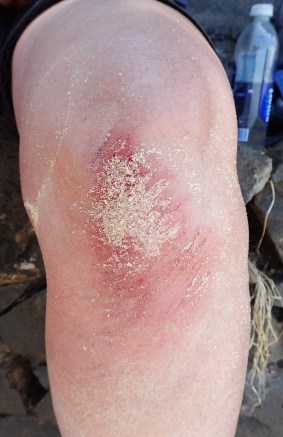 This hiker fell heavily and sustained deep gashes on her knee. Having cleaned and irrigated the wound thoroughly, Celox clotting agent stopped the bleeding instantly. It was then bandaged for the remainder of the hike